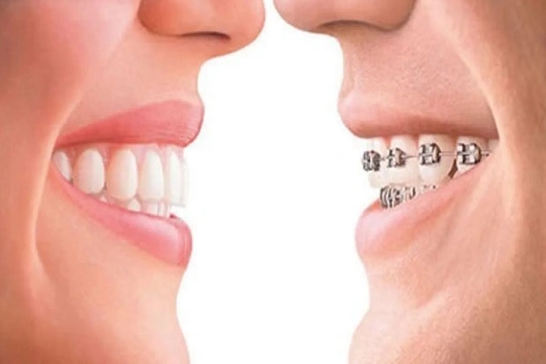 Metal/Ceramic Braces or Clear Aligner Therapy? - Morgan Orthodontics -  Leesburg Braces
