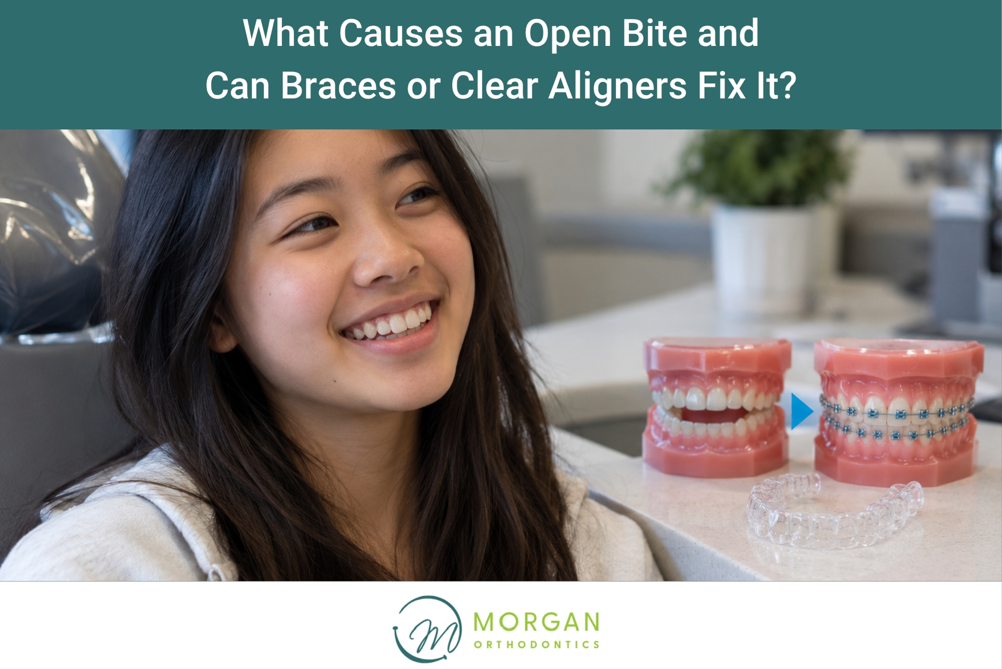 What Causes an Open Bite and Can Braces or Clear Aligners Fix It?